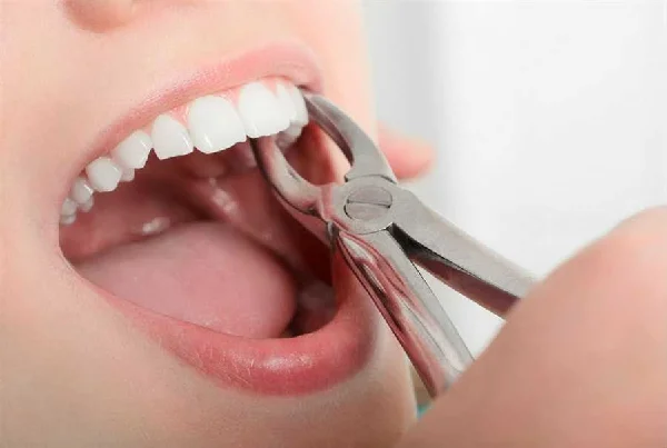 Tooth Extraction
